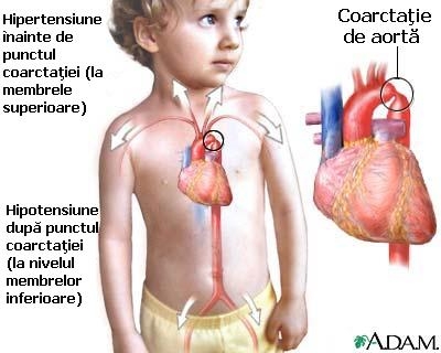 Cardiopatiile congenitale cu shunt veno-arterial - tetrada fallot